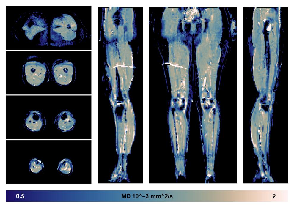 IVIM corrected whole leg muscle mean diffusivity obtained from diffusion tensor imaging.